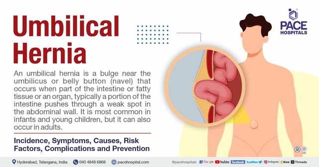 Umbilical hernia Symptoms Causes Complications and Prevention